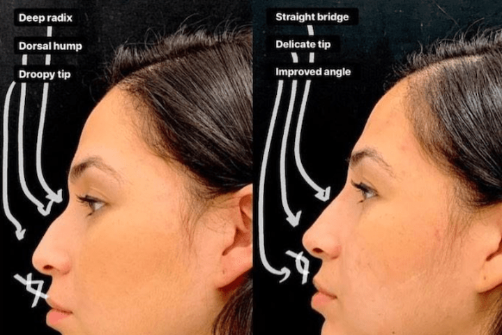 Non-Surgical Rhinoplasty