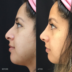 Non-Surgical Rhinoplasty_img_1