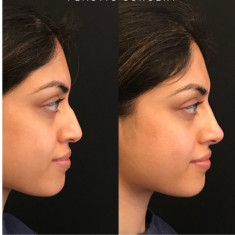 Non-Surgical Rhinoplasty_img_3