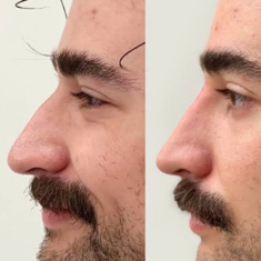 Non-Surgical Rhinoplasty_img_2