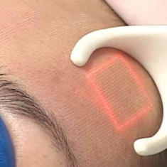 Laser Treatment_img_3