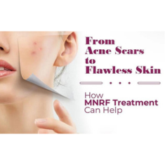 Microneedling Radiofrequency(MNRF)_img_2