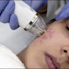 Microneedling Radiofrequency(MNRF)_img_1