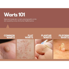 Mole, Skin Tag, and Wart Removal_img_1