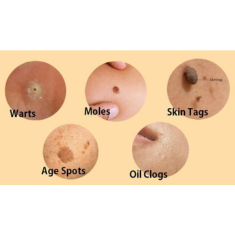 Mole, Skin Tag, and Wart Removal_img_2