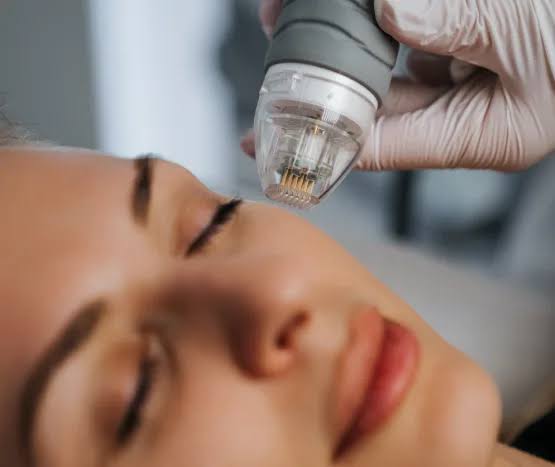 Microneedling Radiofrequency(MNRF)