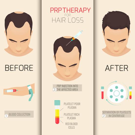 Platelet-Rich Plasma (PRP) Therapy